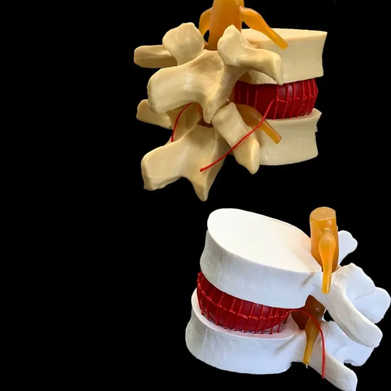 Examination Bed Medical - Anatomical Human Lumbar Vertebrae Degenerative Lumbar